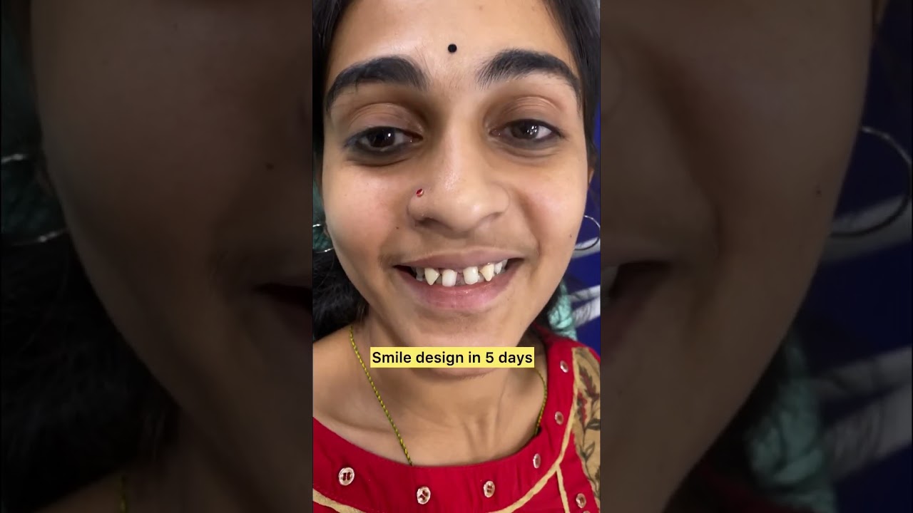 Smile design in 5 days,#smilemore #vijayadental#hyderabad #smiling #teeth#ytshorts