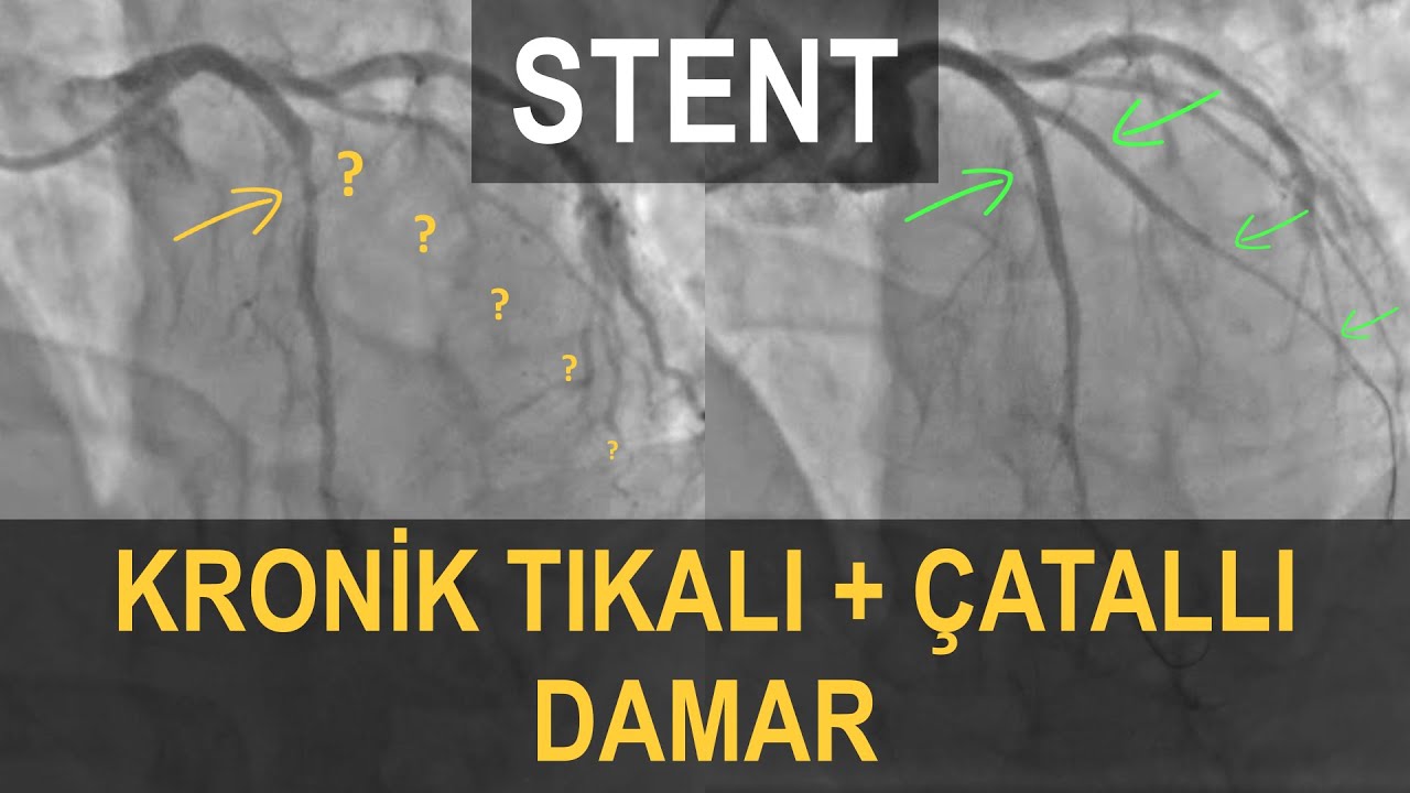STENT | Çatallı (Bifurkasyon) + Kronik Tıkalı Damar (CTO) Vakası