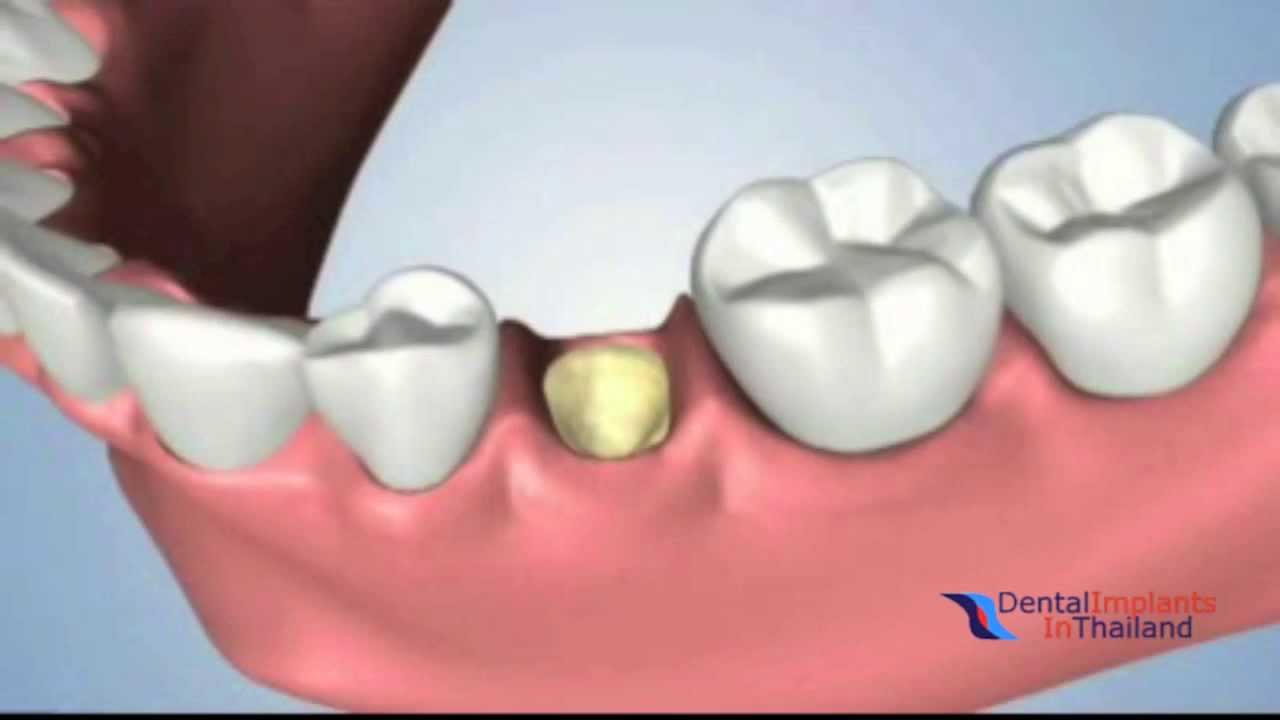Extraction Ridge Preservation and Socket Grafting With Alveolar Ridge Preservation in Bangkok 3D