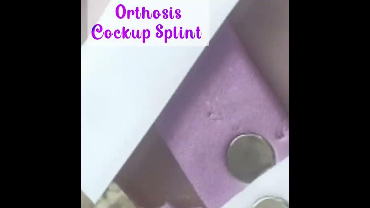Cockup splint for wrist drop....for correction of wrist drop deformity 