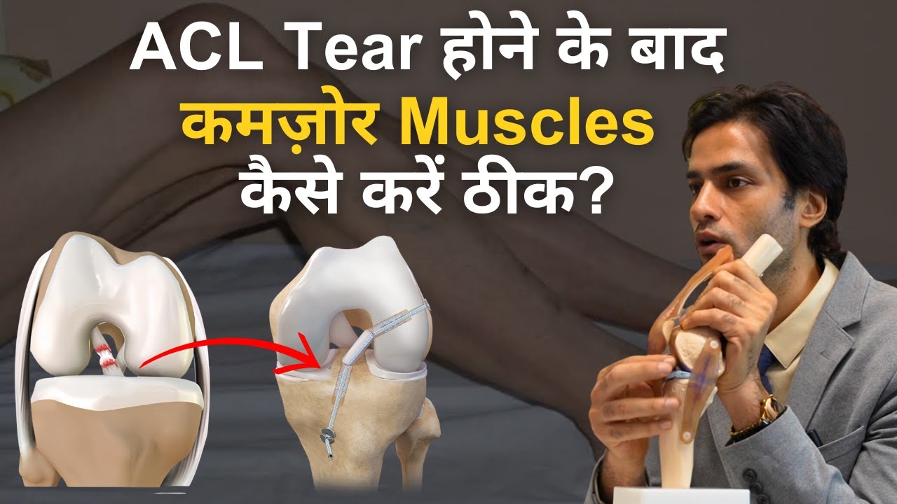 ACL Injury होने के बाद कमज़ोर Muscles कैसे करें ठीक? ACL Tear in 1 Leg, Best Treatment