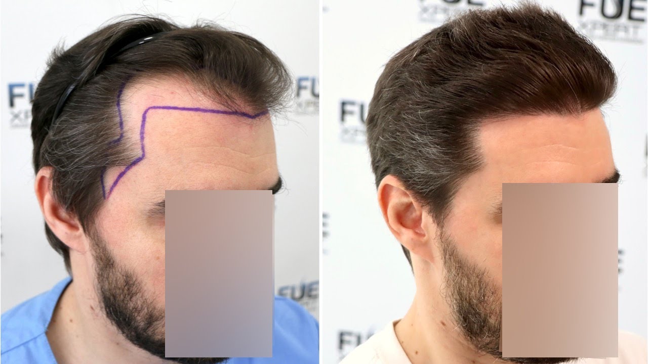 3217 Grafts FUE Hair Transplant by Dr  Juan Couto at FUExpert Clinic, Madrid, Spain