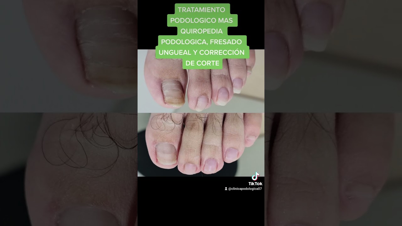 U&Ntilde;AS AMARILLAS CON MUCHA COSTRA 😨😨 RESTAURADAS TOTALMENTE 😏👍✅️  HAZ TU CITA #youtube #suscribete