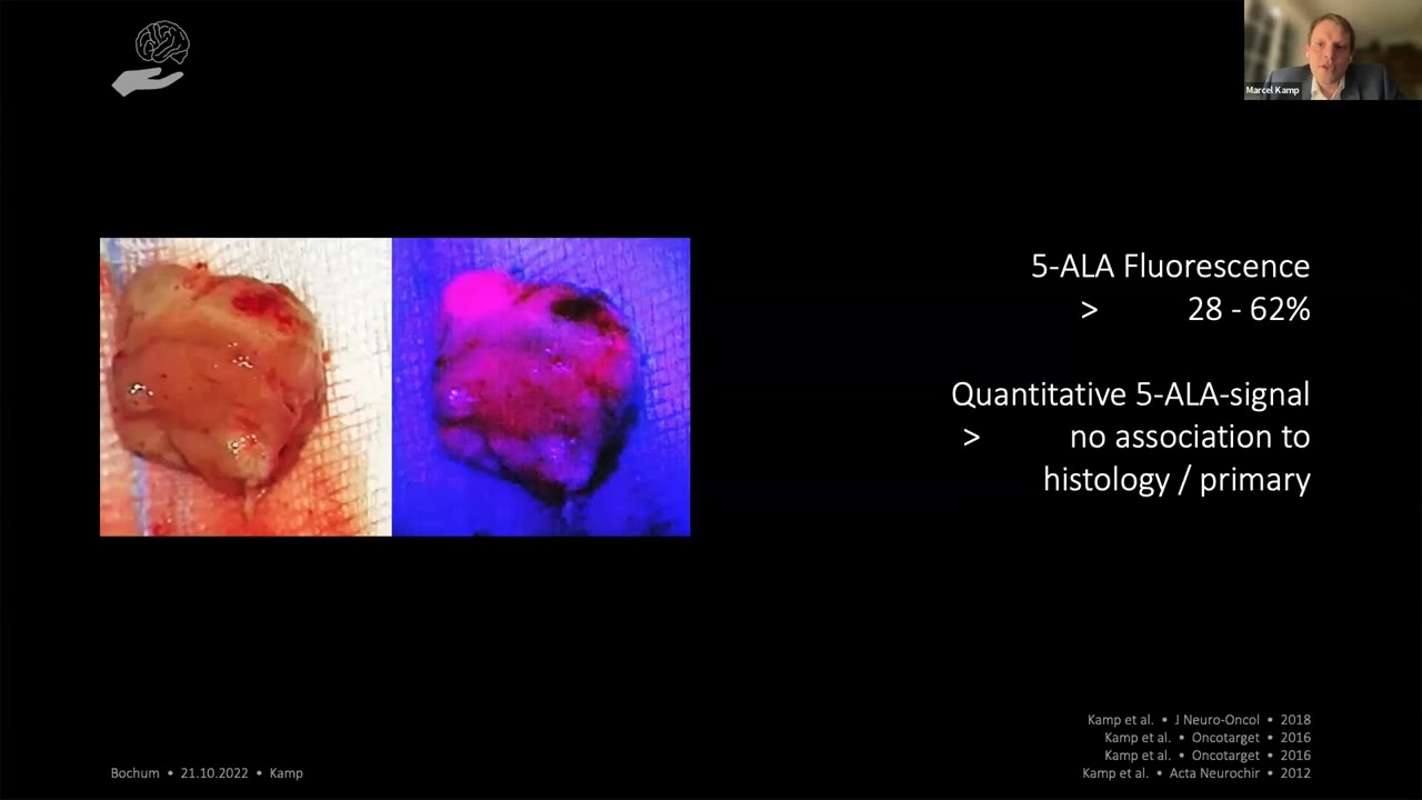 EANS WEBINAR: BRAIN METASTASES