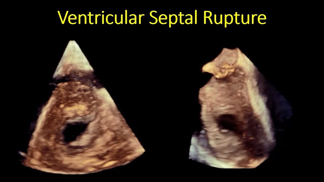 2D/3D-TOE assessment of VSR post infarction