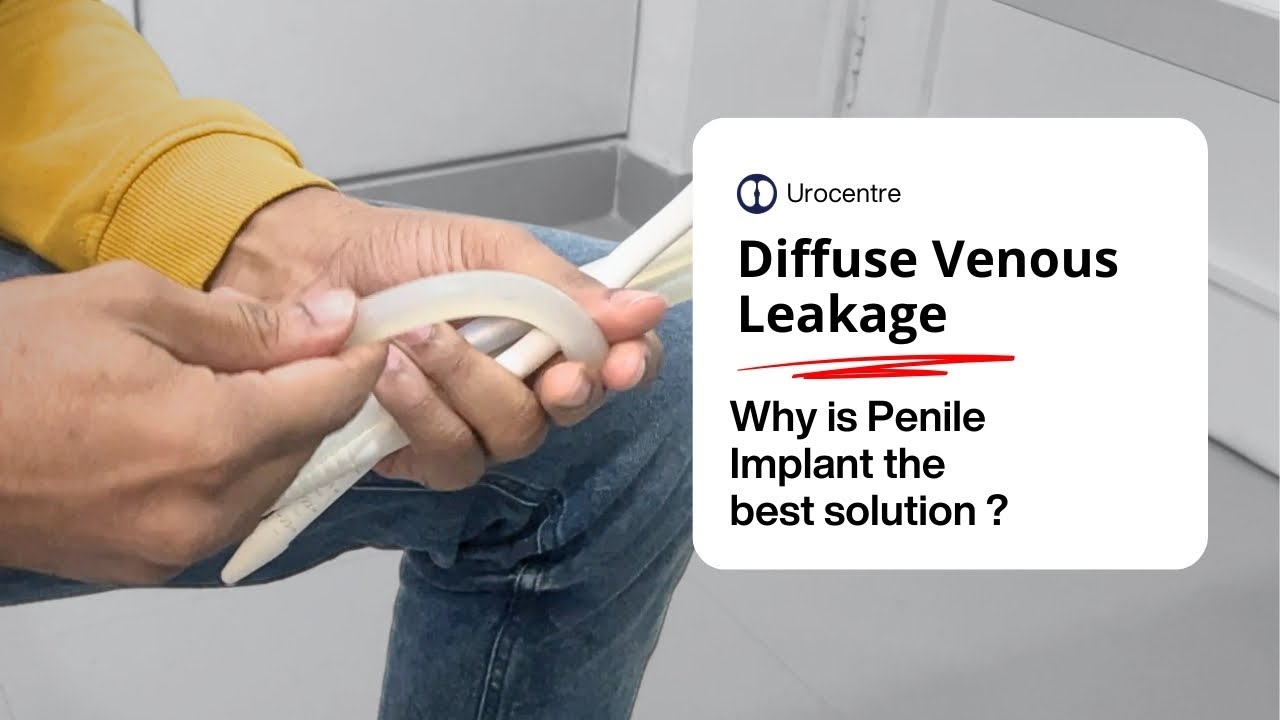 Diffuse Venous Leakage: Penile Implant is the best Solution.