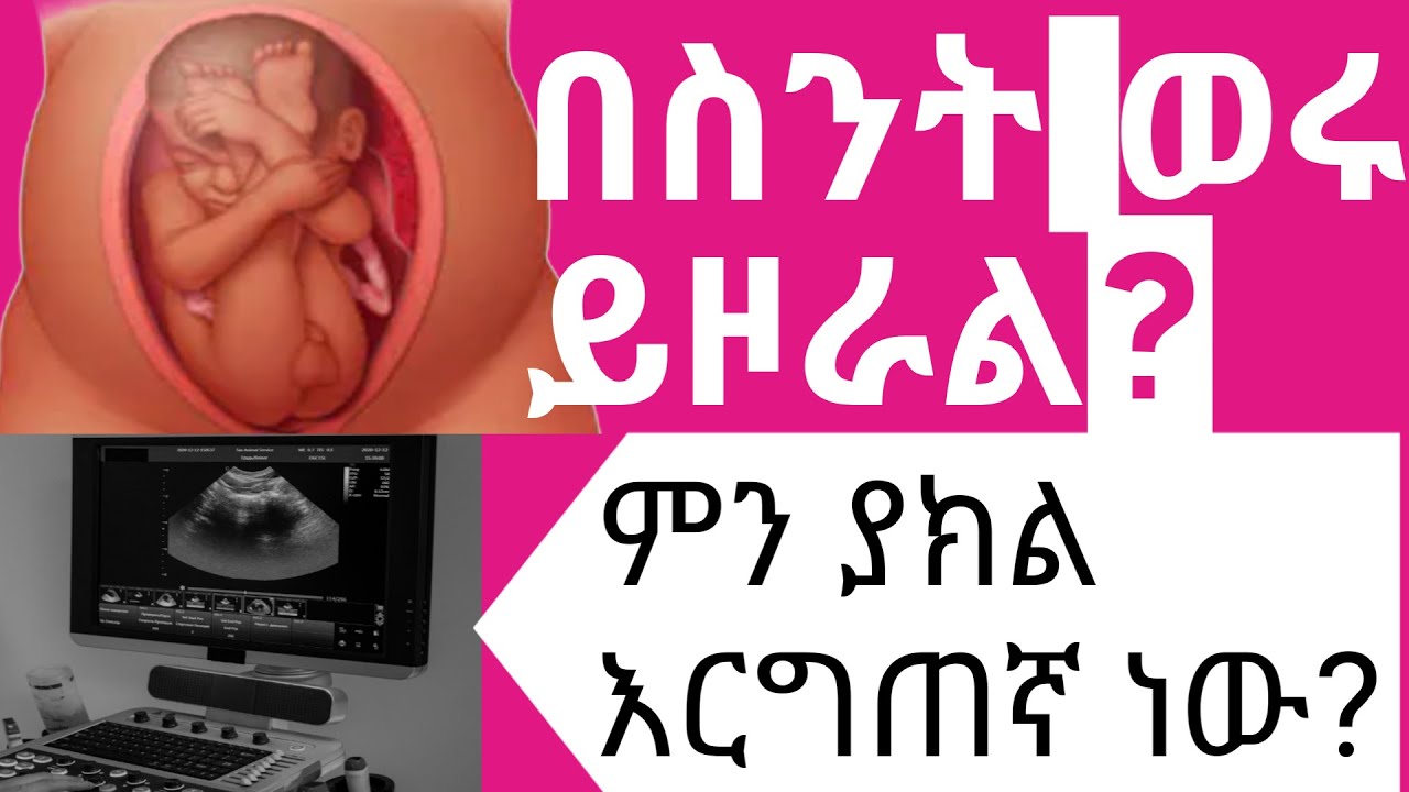 የጽንስ አቀማመጥ በራሱ የሚስተካከልበት ትክክለኛው ጊዜ/When does baby turn from breech to cephalic?