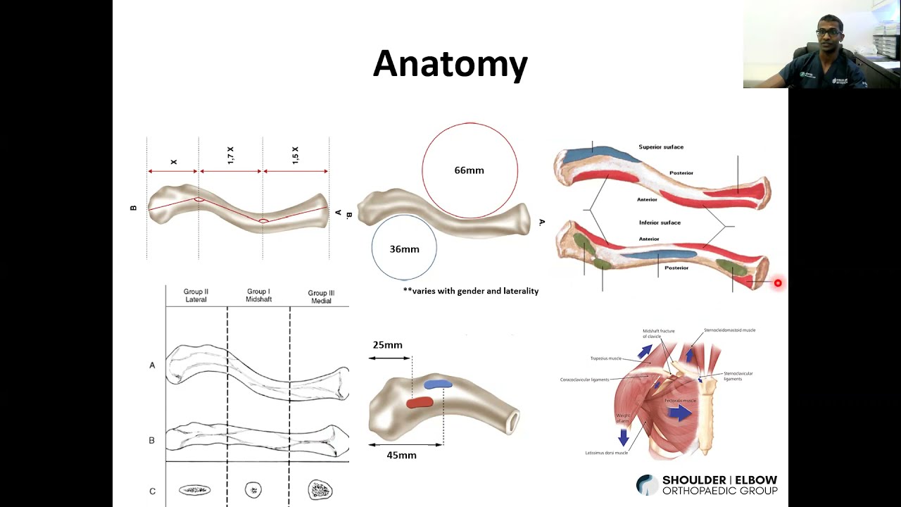 Dr Ruben Manohara from SEOG in Singapore: How to Avoid Complications in Clavicle Fracture Fixation
