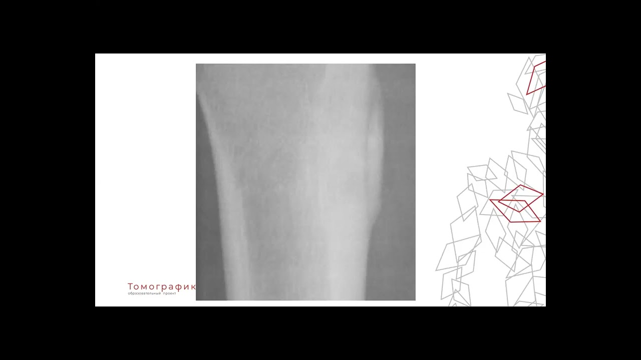 Остеоид остеома