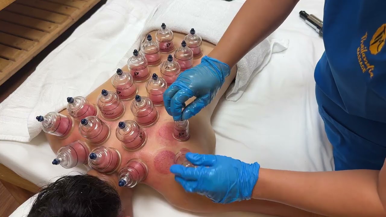Cupping Massage - the healing power of suction
