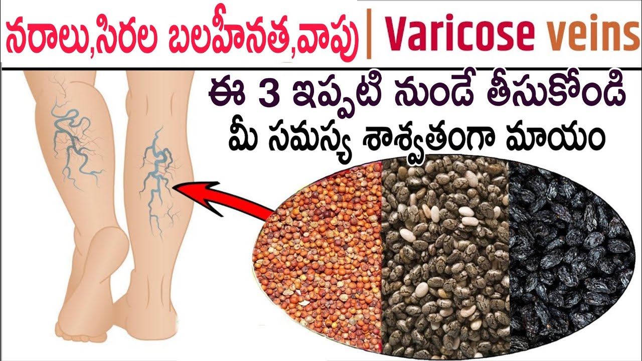 3 సార్లు - వెరికోస్ వెయిన్స్,మీ నరాలు,సిరల్లో వాపు,బలహీనత, సమస్యను శాశ్వతంగా దూరం చేసుకొండి