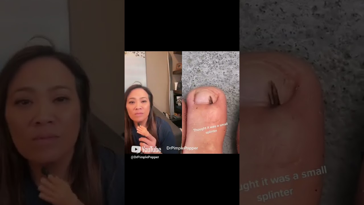 Dr Pimple Popper vs a Small Splinter