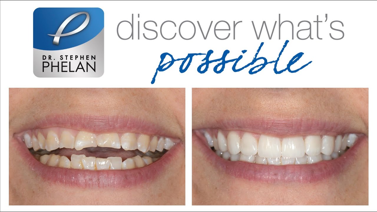 Full mouth rehabilitation for advanced tooth wear and erosion case study by Dr. Stephen Phelan