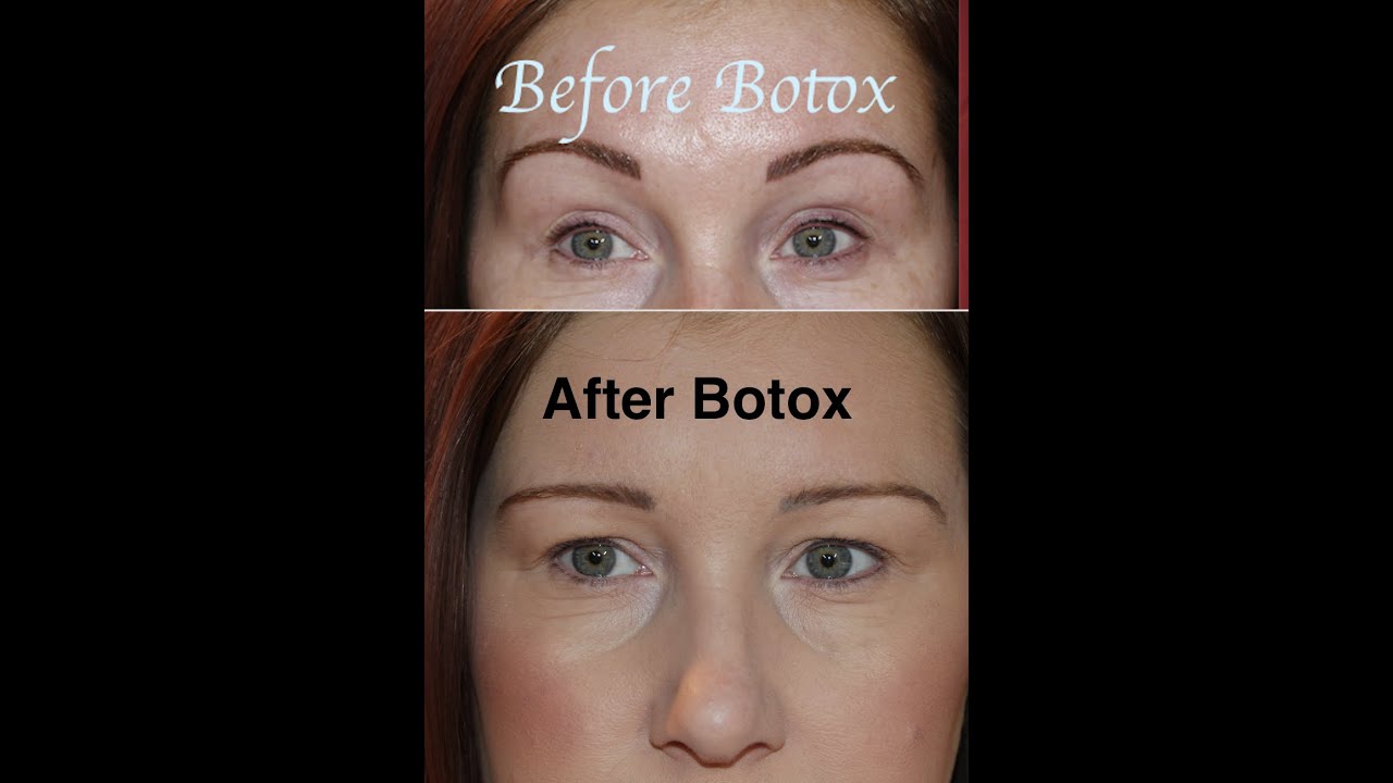 Botox Gone Wrong! - Before & After - My Story