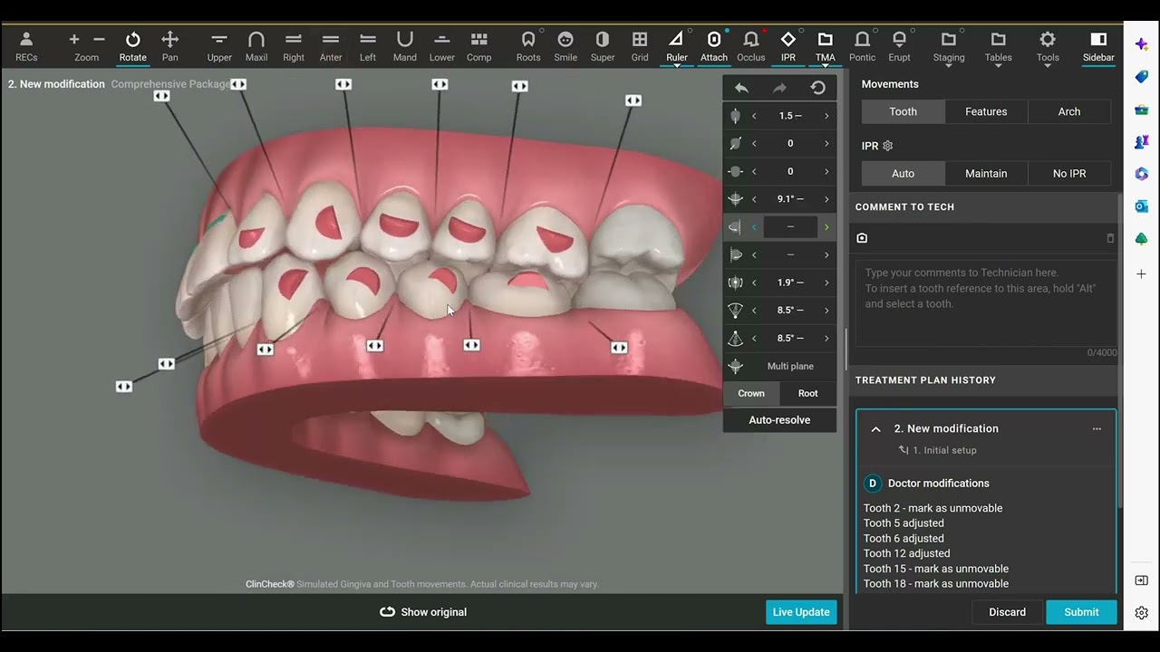 3D Controls: How to Shorten an Invisalign® Treatment Plan