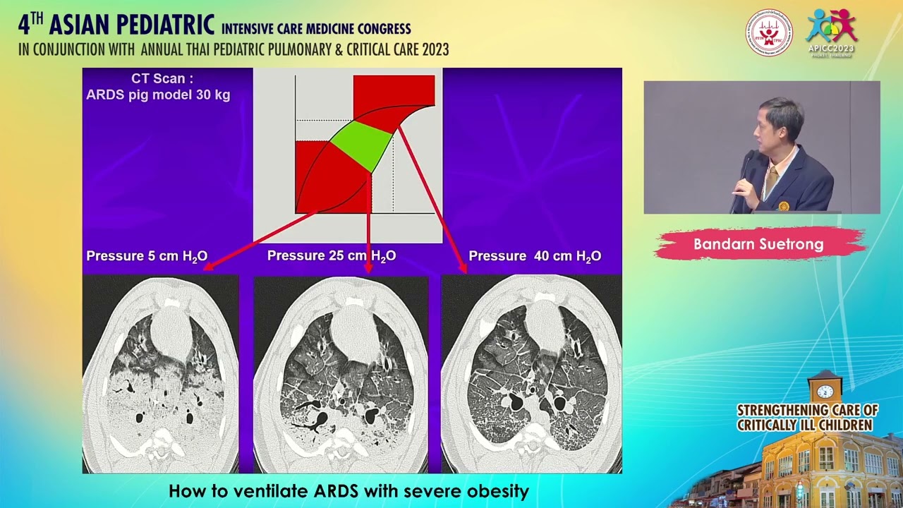 How to ventilate ARDS with severe obesity