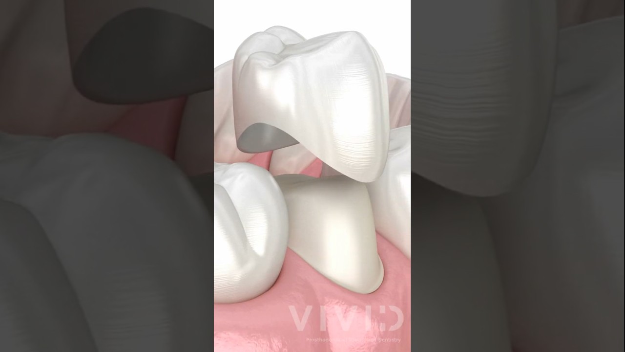 What Are Dental Crowns? Types & Benefits Explained by a Prosthodontist
