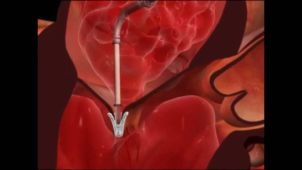Mitral Valve Clip Repair Procedure-How It Works