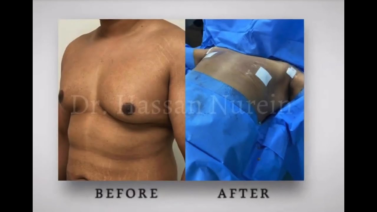 Gynecomastia Surgery Transformations by Dr. Hassan Nurein | Before & After Results