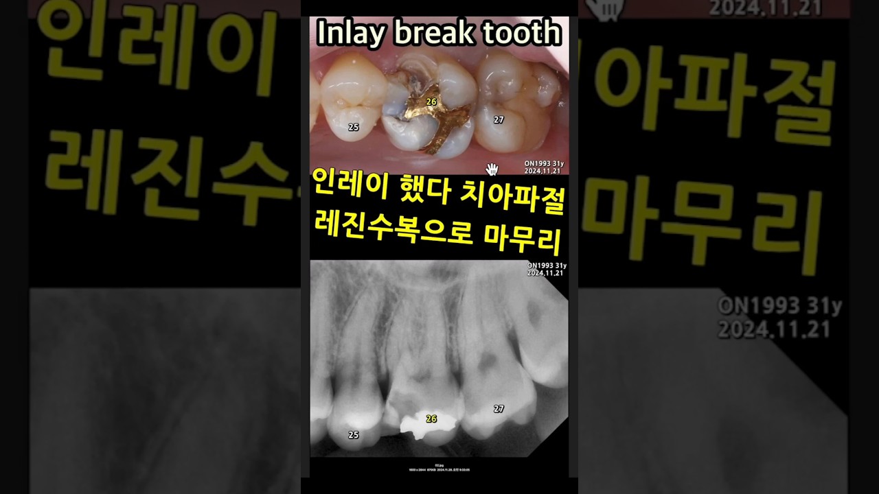 인레이 했다 치아파절. 레진수복으로 마무리. 크라운 불필요. 인레이했다 치아파절되서 크라운했다 치아사망해서 임플란트 하는 치아악순환 2024_11_30