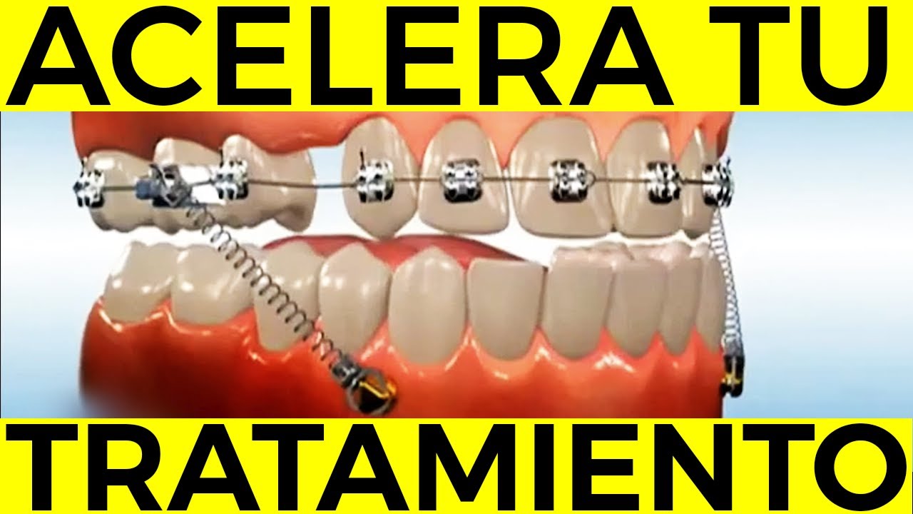 ¿Cómo CORREGIR y MEJORAR mis DIENTES CHUECOS con Minitornillos y Brackets? Secretos de la ortodoncia