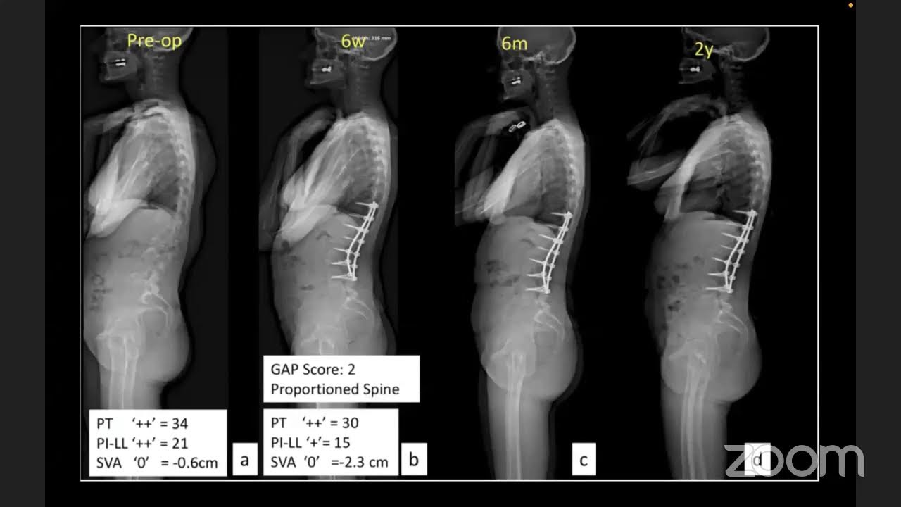 Balance Sagital - GAP Score - Yovany Capacho, MD