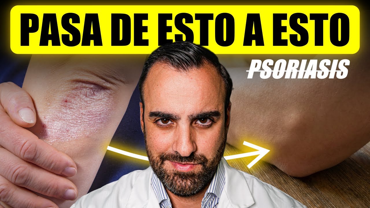 Psoriasis ¿Cómo se cura?