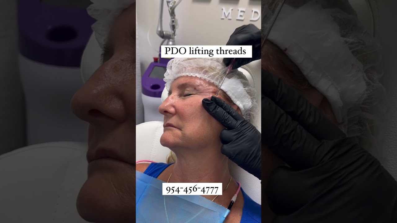 PDO. Vertical lifting and mid face. Patient only choose 3 per side.  #shorts