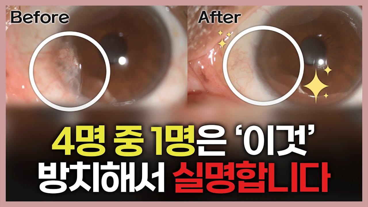 이게 백내장이 아니라고요? 익상편(군날개)의 모든 것! [ENG SUB]
