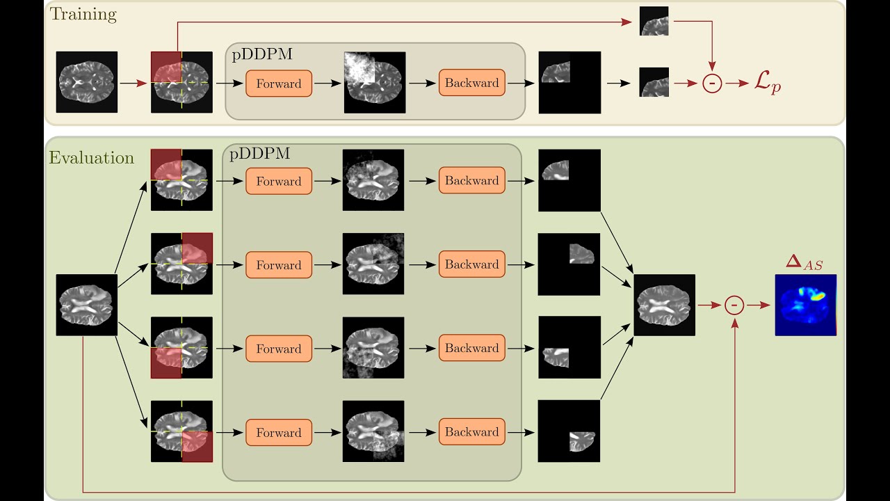 [P083] Patched Diffusion Models for Unsupervised Anomaly Detection in Brain MRI