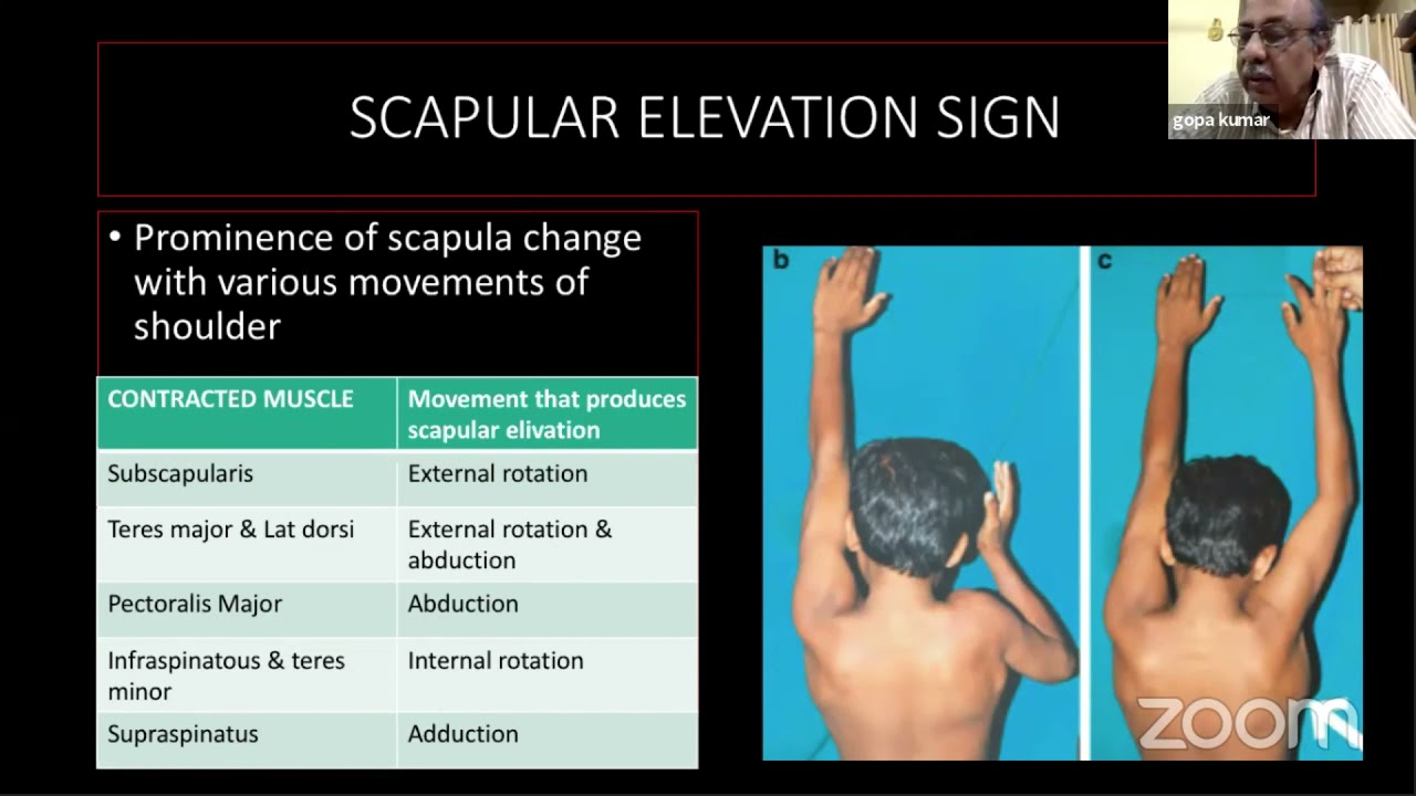 Sprengel Shoulder - Dr Gopa Kumar
