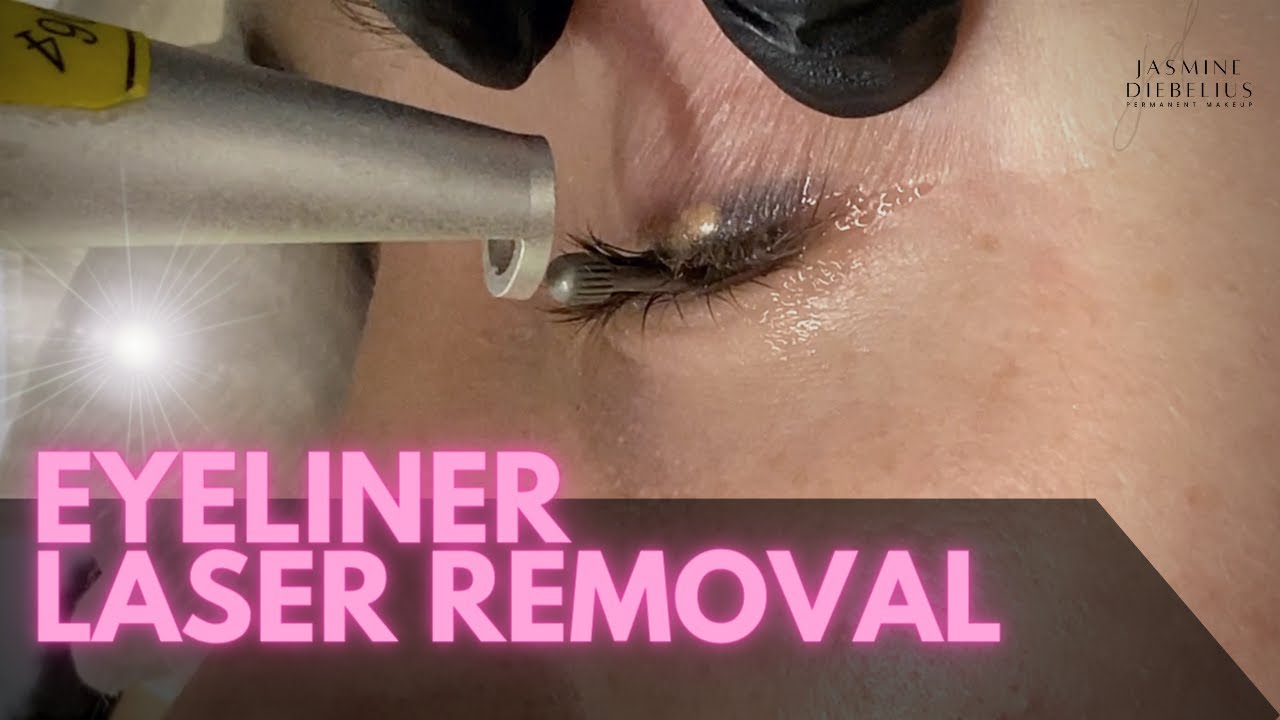 Eyeliner Removal - Laser Treatment
