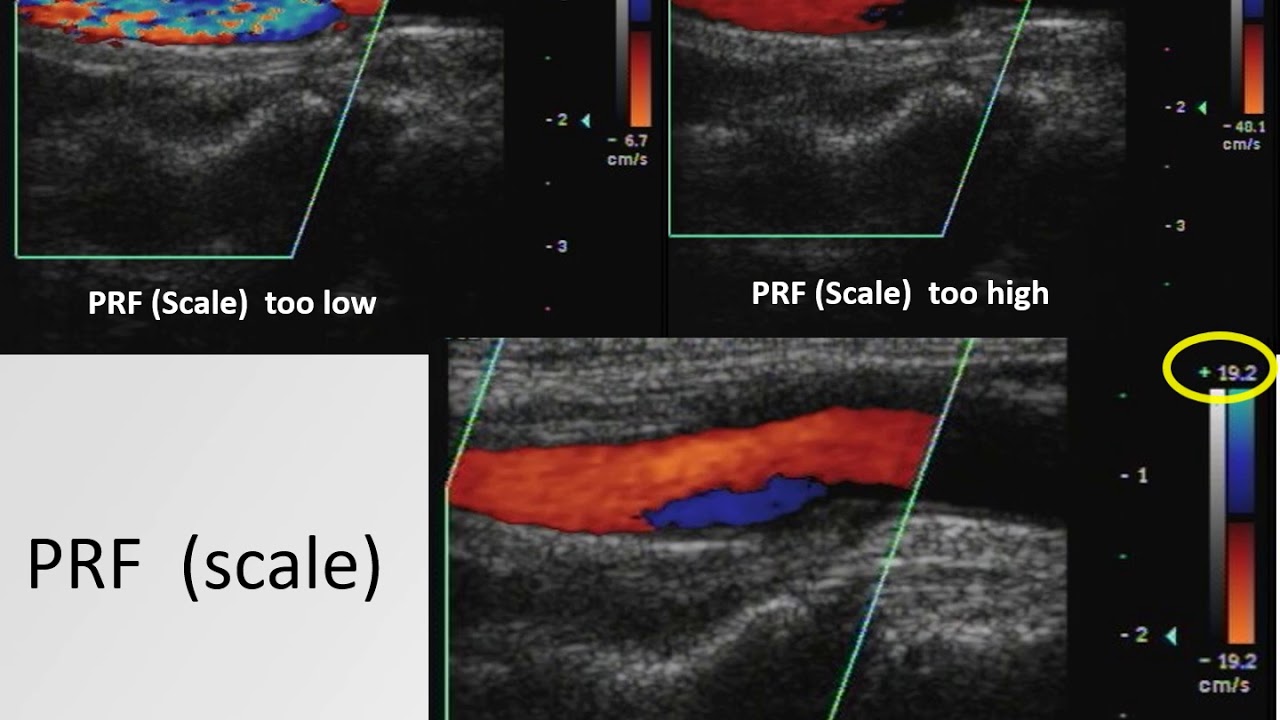 Technical Tip Tuesday on Virtual Vascular Lab Channel
