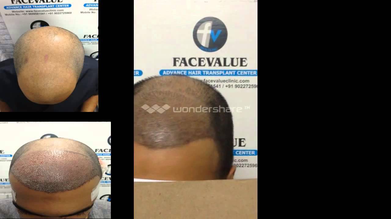 Hair Transplant FUE FUT India, www facevalueclinic com 1