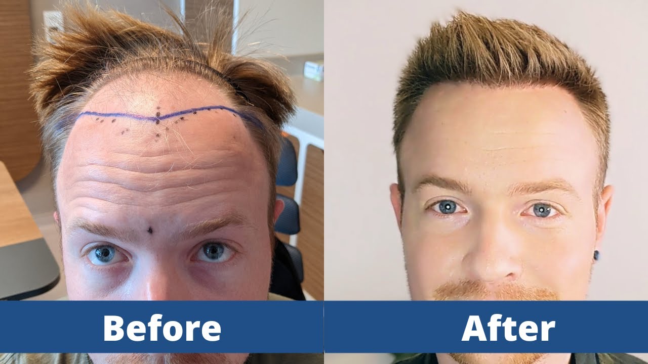 La pousse capillaire de Robin après sa greffe de cheveux | Elithair