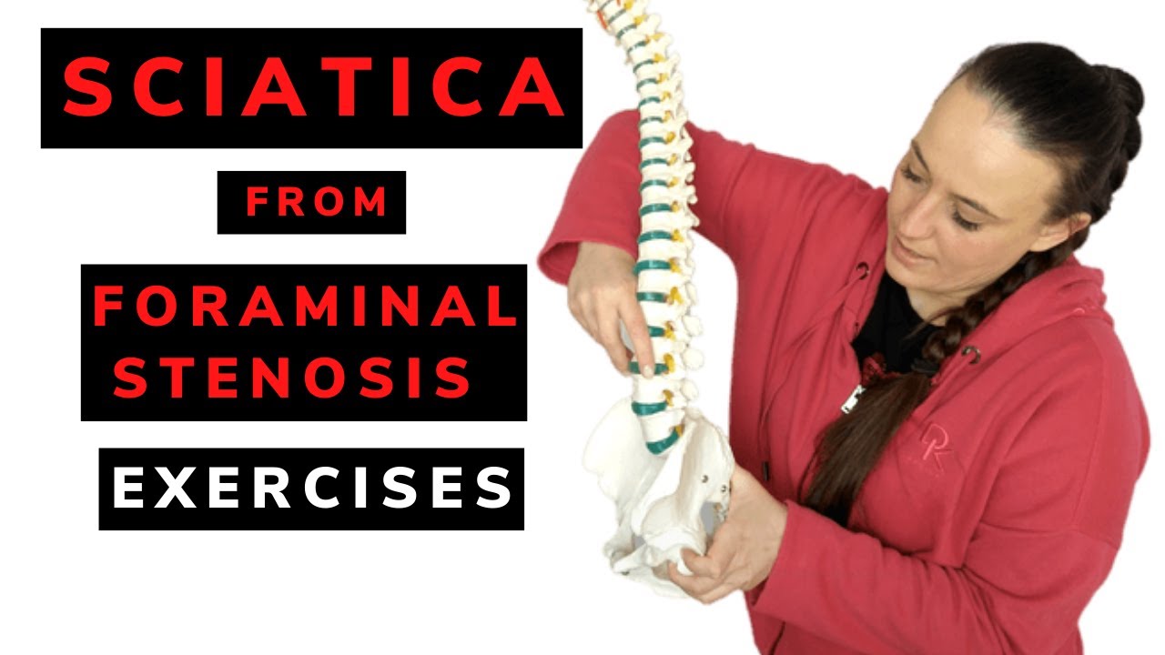 Sciatica from foraminal stenosis - exercises.