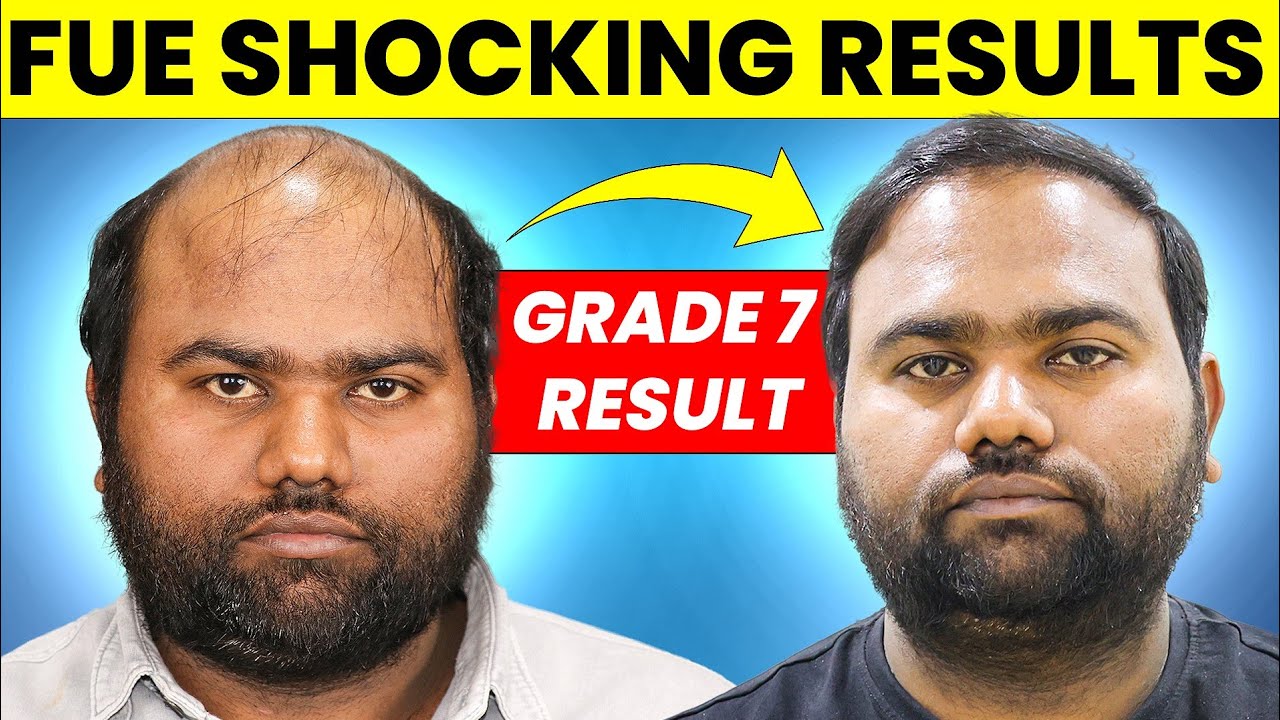 Shocking FUE Hair Transplant Results Month by Month | Hair Transplant Results 2024