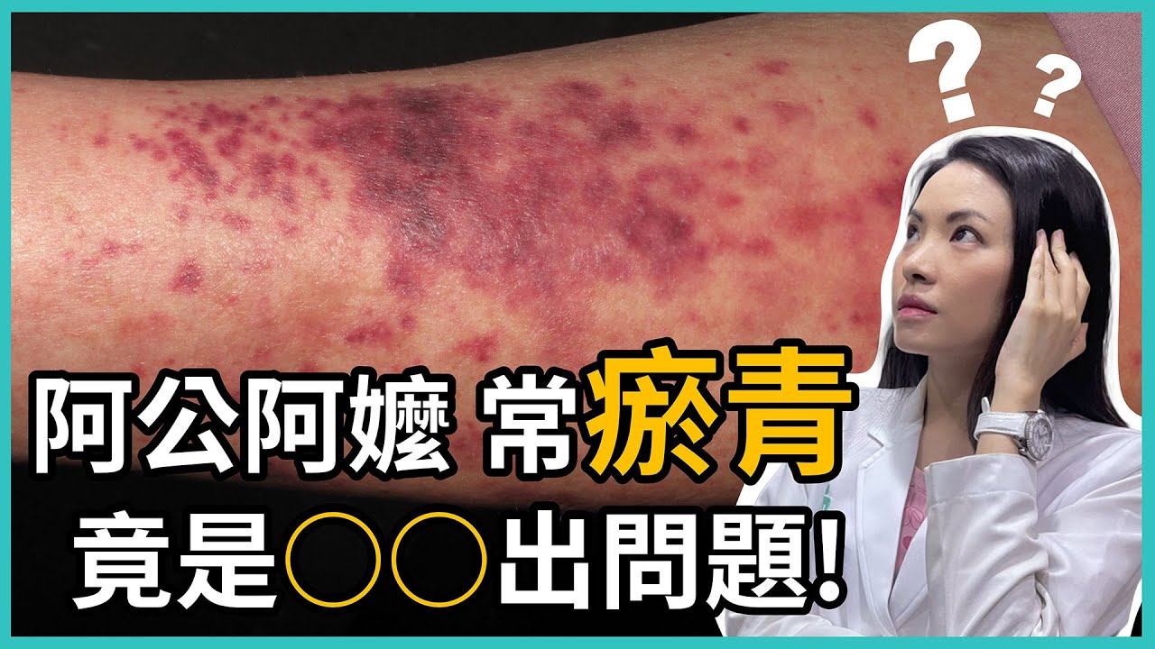 阿公阿嬤手腳皮膚常瘀青，原來是老年性紫瘢症！對身體有影響嗎？讓皮膚科林昀萱醫師來告訴各位吧！