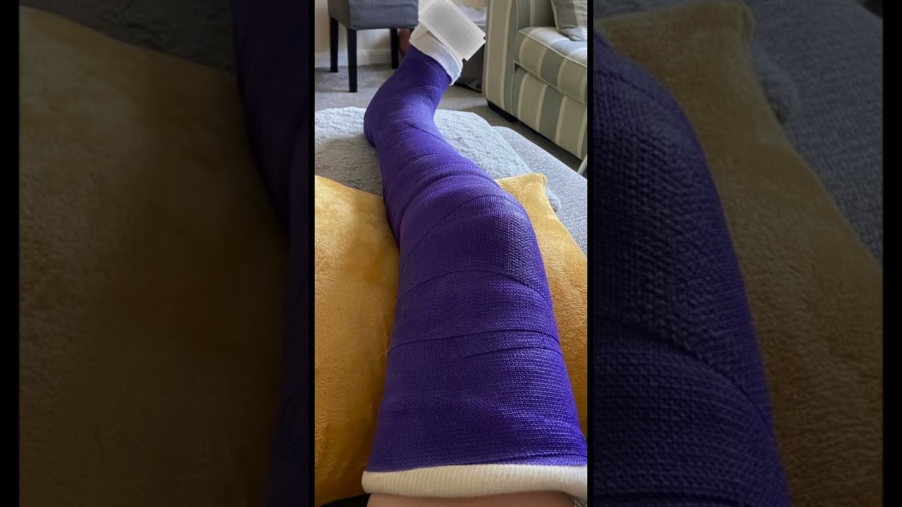 Broken leg stransformstion #recoveryjourney #brokenleg #foryou #timing