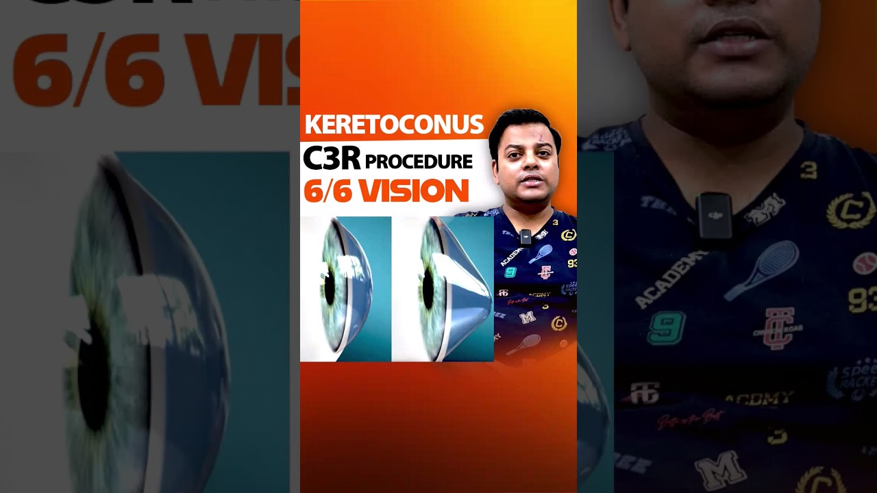 Treatment for Keratoconus : C3R