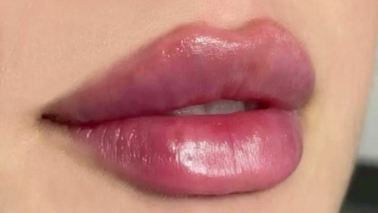 2ml lip filler- BIG PLUMPY LIPS SUBLIMINAL