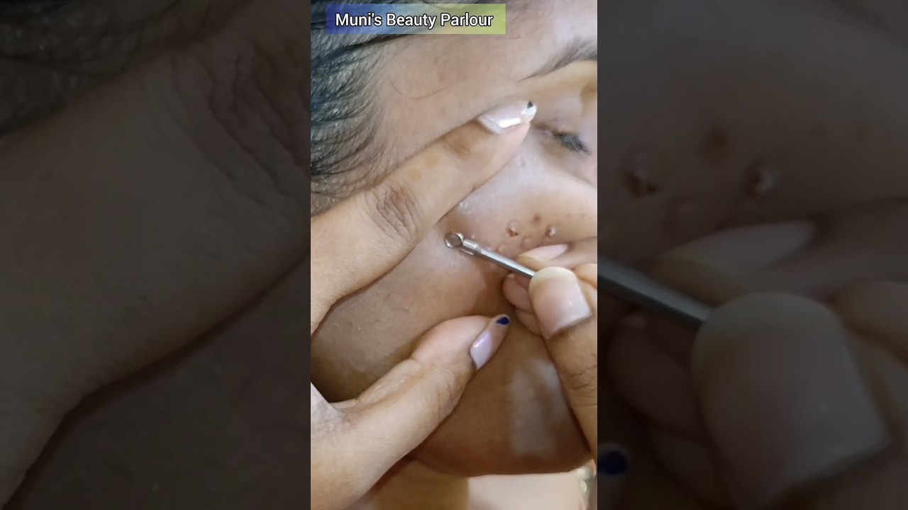 Pimple Free😃 Amezing Clean up🤩