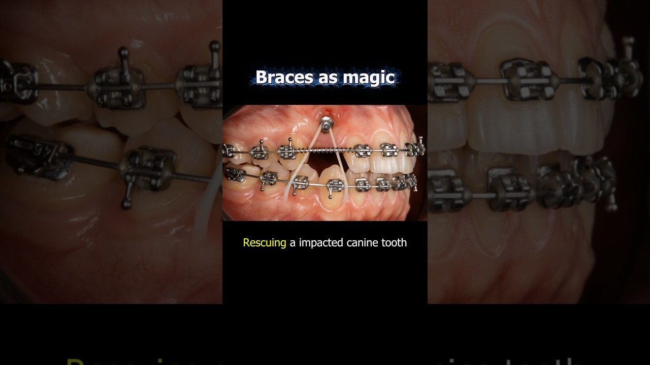 Magic braces, rescuing a impacted canine tooth #braces #orthodontist #dentist #teeth #orthodontics