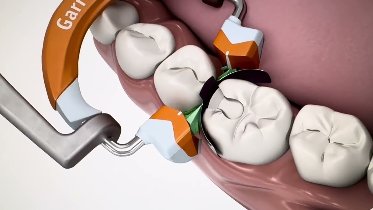 Composite filling procedure