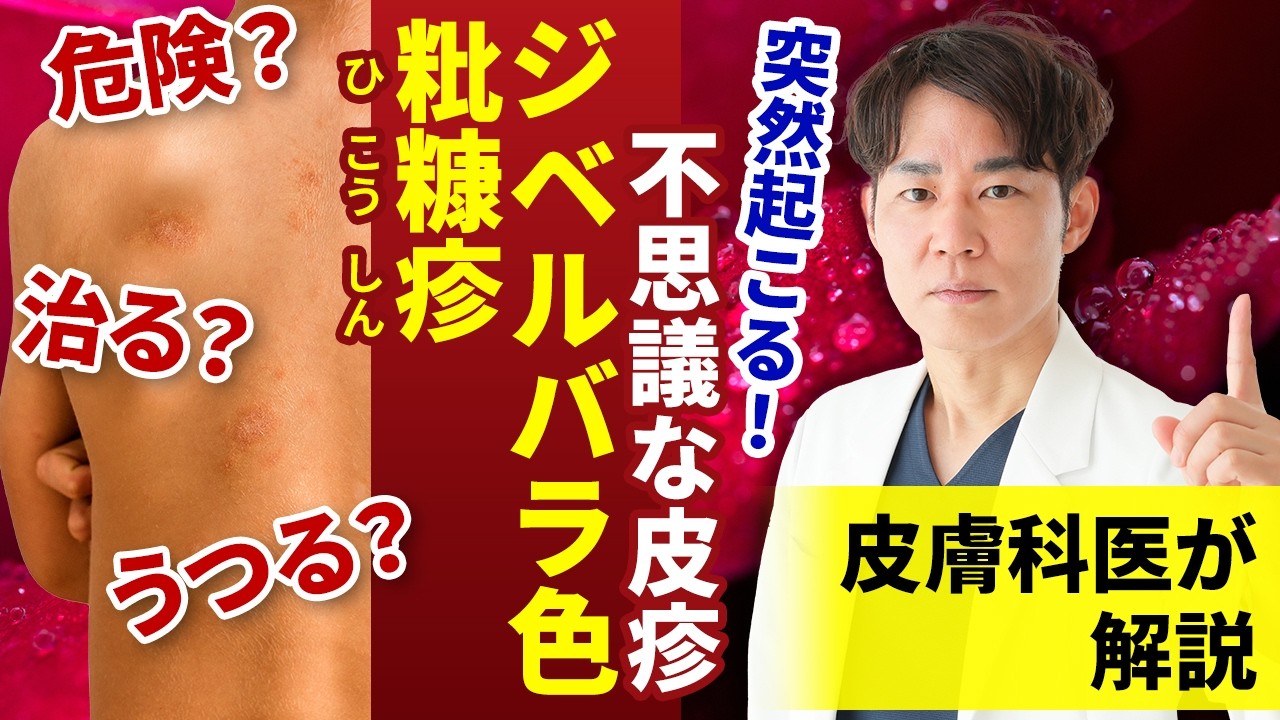 【科学で解説】ジベルバラ色粃糠疹（じべるばらいろひこうしん）ってどんな病気？