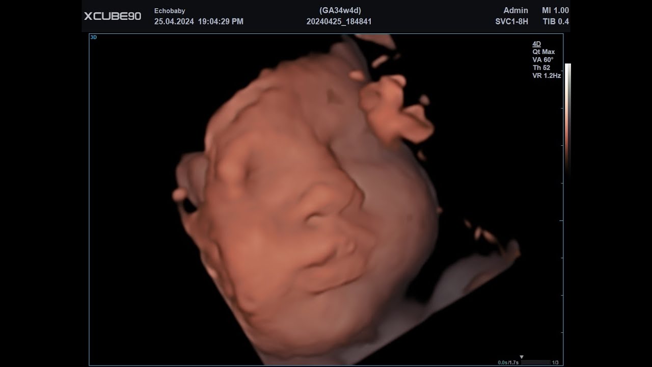 34 Weken Zwanger, 3D Echo