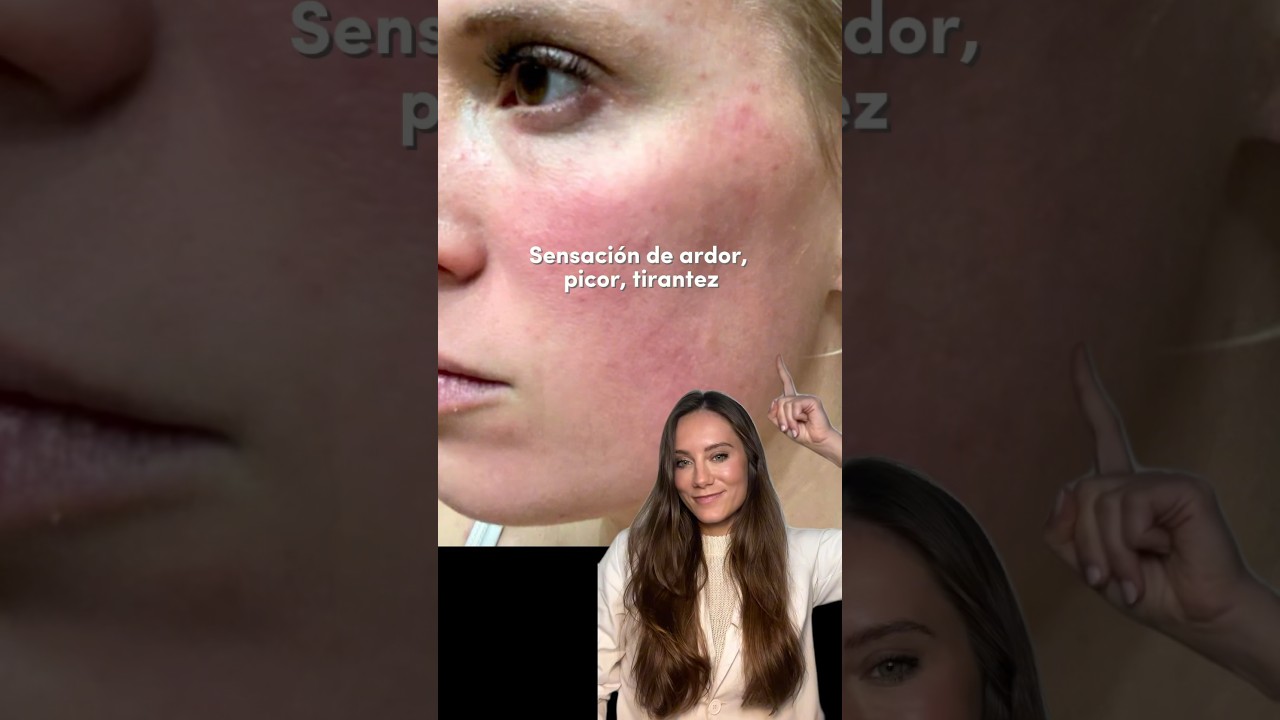 C&oacute;mo se ve y se siente la #rosacea #dermatologist #skincare