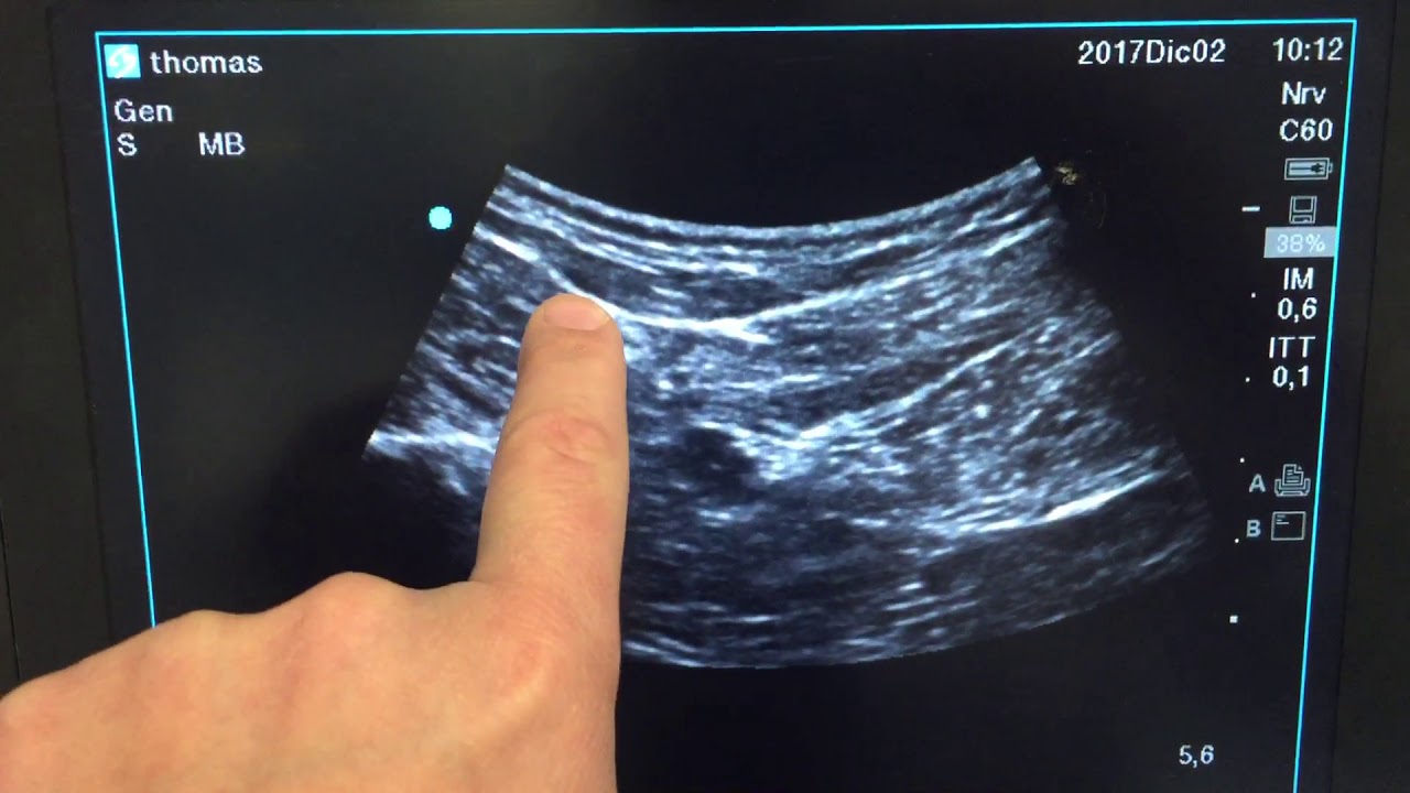Sciatico nerve block lateral approach