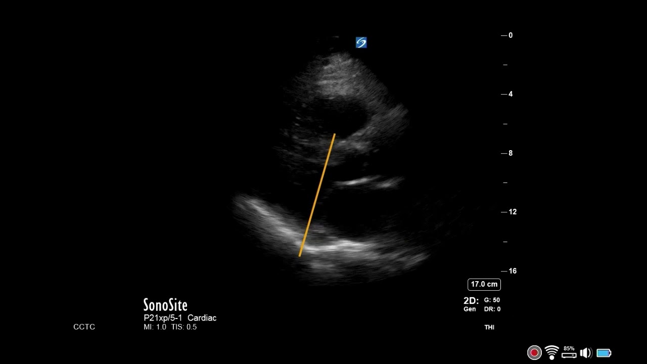 How to...Measure MVA by Planimetry