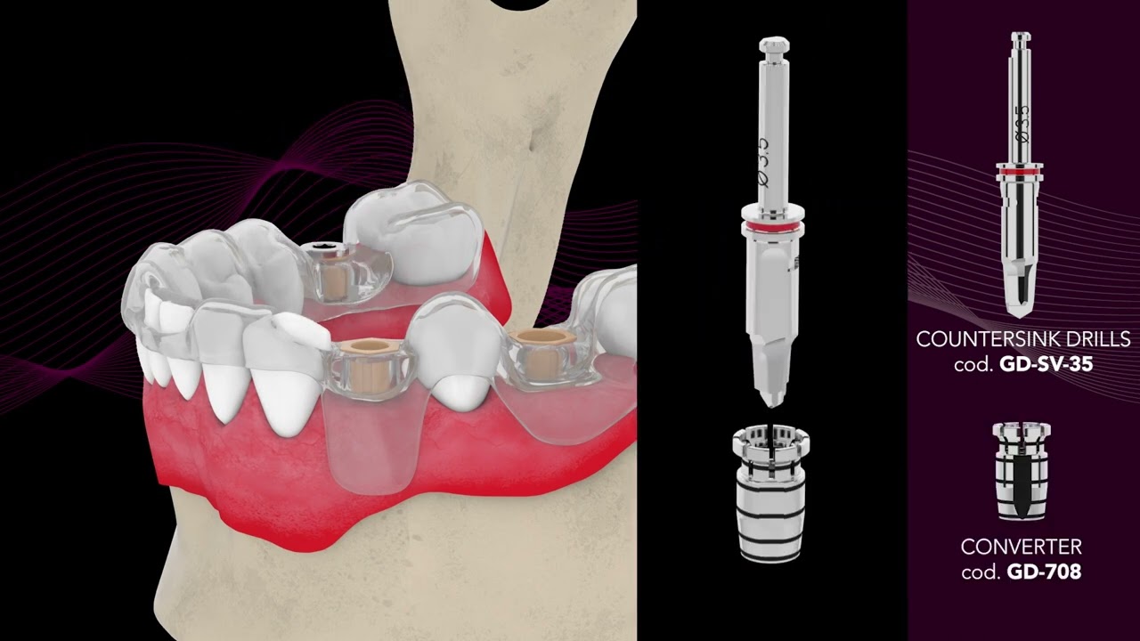 B&B Dental | Guided surgery technique